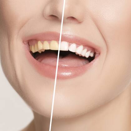 Was tun gegen gelbe Zähne? The female teeth before and after whitening. Collage with before and after concept