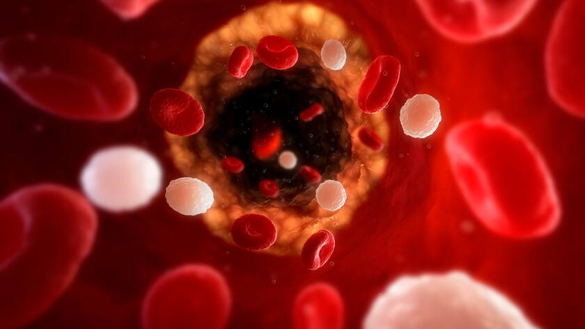 Cholesterin Cholesterol Arteriosklerose Novartis The Medicines Company