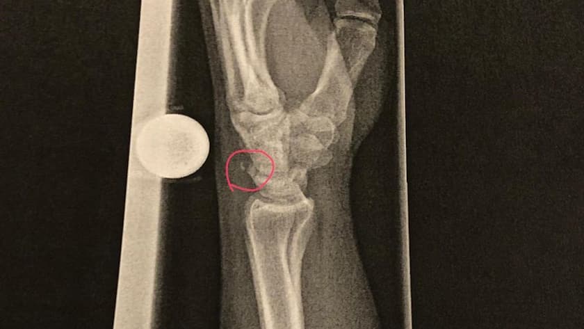 Röntgenaufnahme eines gebrochenen Handgelenks.